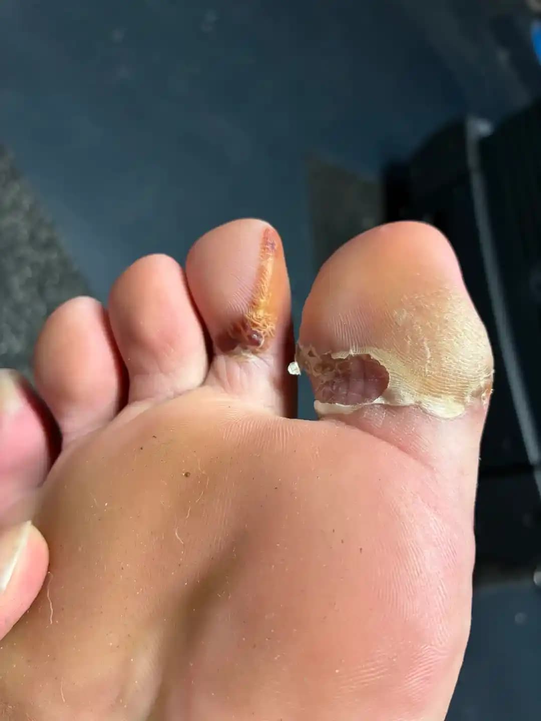 Günde 12 Mil Yürüyüşte Ayaklarda Su Toplamalarının Nedenleri ve Etkili Çözümleri