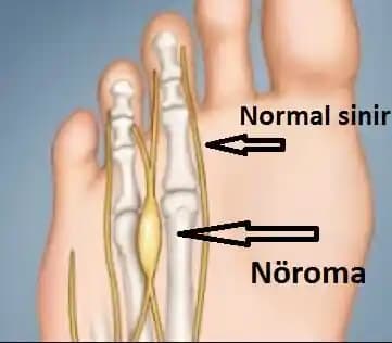 Morton Nöroması İçin Geniş Koşu Ayakkabısı Seçimi ve Ayak Sağlığı Önerileri